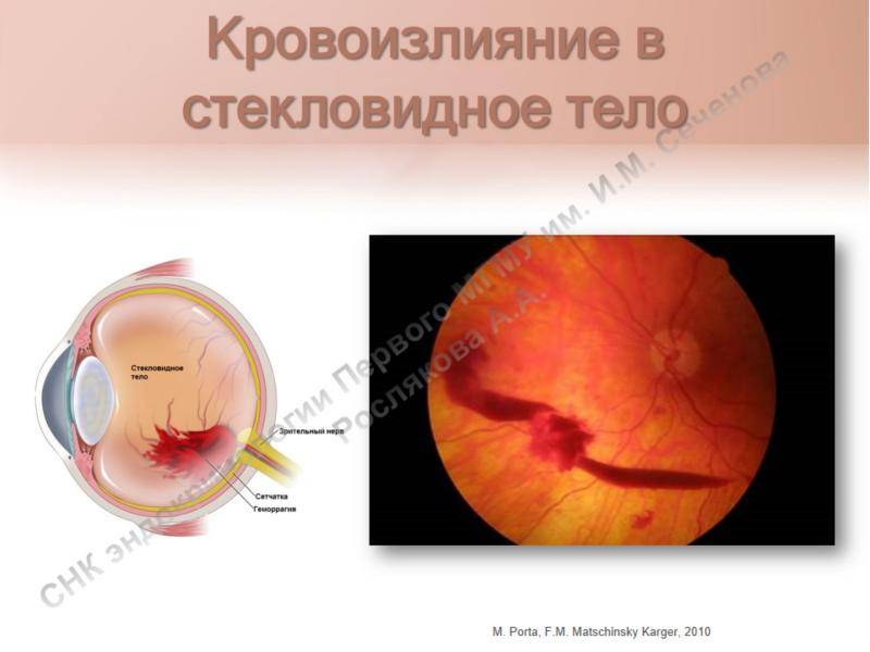 Причины и лечение кровоизлияния в глаз: что делать и как спасти зрение?