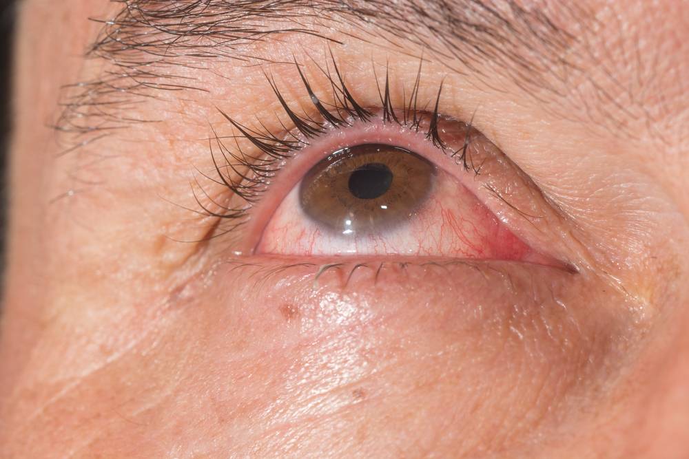 Покраснение глазного яблока: причины и лечение - "здоровое око"