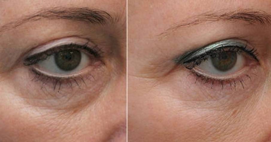 Причины возникновения тёмных кругов и синяков под глазами у мужчин и женщин, лечение