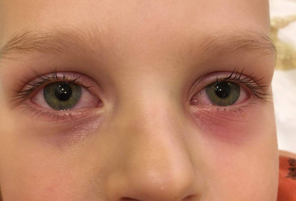 Красные глаза при простуде: основные симптомы