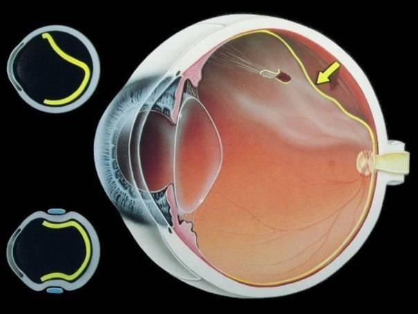 Операция при разрыве сетчатки глаза - показания, как проходит и как вести себя после вмешательства, делается ли по полису омс