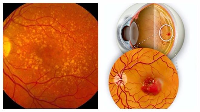 Сосудистая оболочка глаза: строение, функции, симптомы и лечение