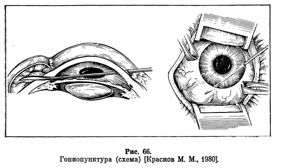 Лазерная иридотомия (иридэктомия) при глаукоме