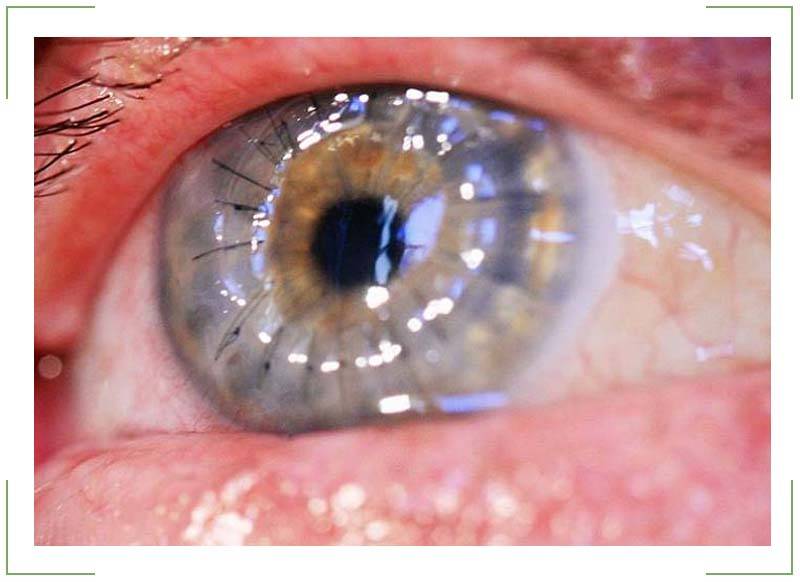 Пленка на глазу у человека - стадии развития птеригиума, причины проблемы,  другие внутренние причины