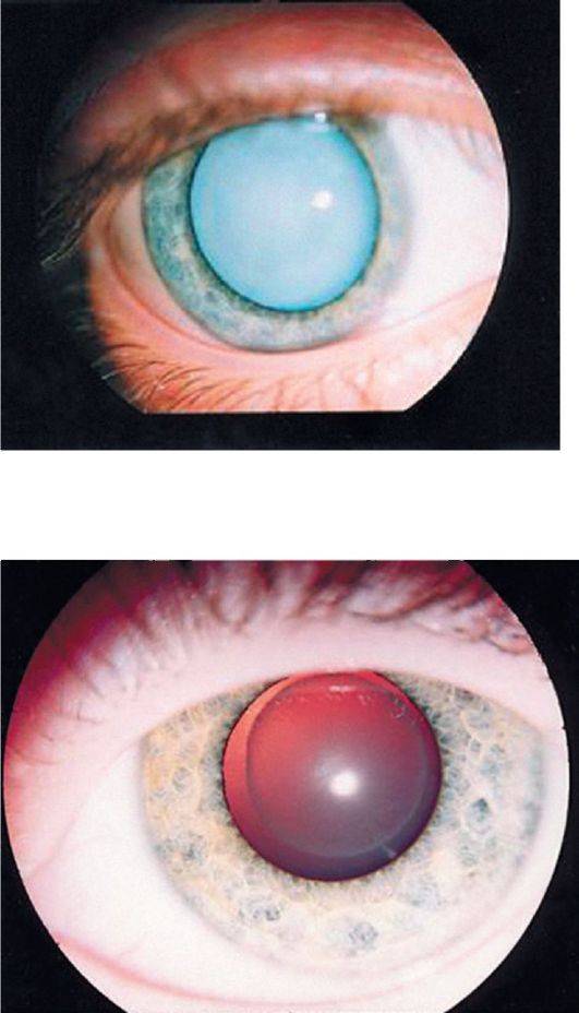 Врожденная катаракта у детей: категории детей с нарушениями зрения, каковы виды, причины возникновения такого заболевания и лечение