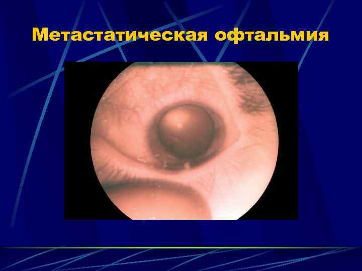 Симпатическая офтальмия - что это, симптомы, причины и лечение