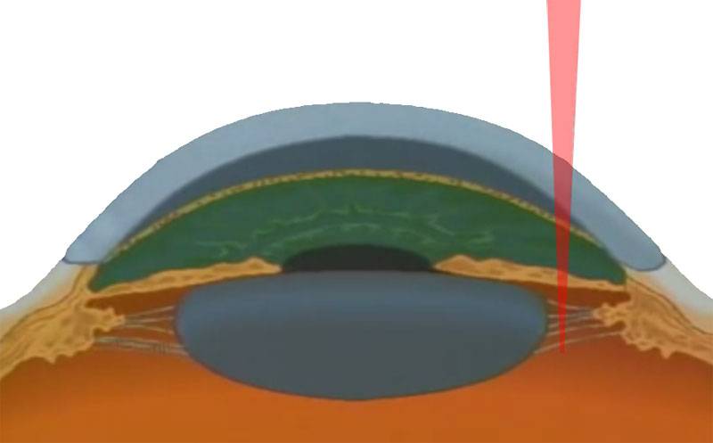 Лазерные операции на глаукоме – иридэктомия и трабекулопластика