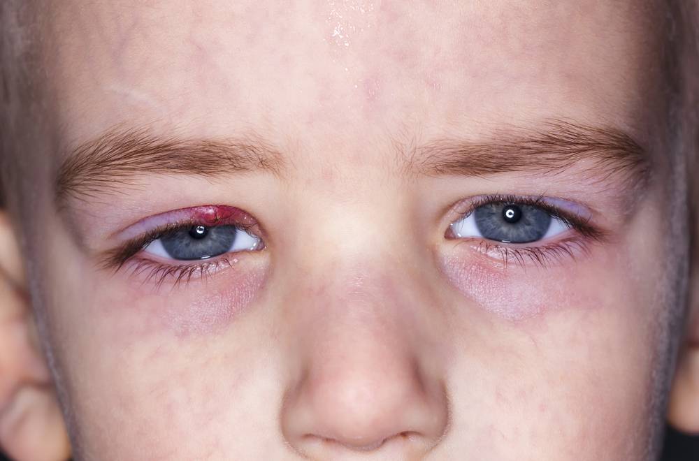 Ячмень на глазу ребенка: как правильно лечить и можно ли предупредить появление?