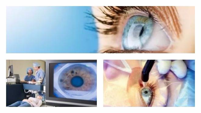 Лазерная коагуляция сетчатки глаза: как проводится, послеоперационный период, осложнения, фокальная, разрыв, после