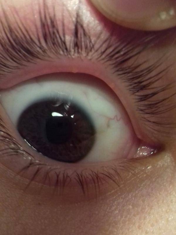 На белке глаза пузырек - что это и как лечить возникший симптом