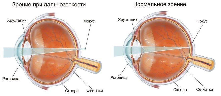 Близорукость: это минус или плюс, как определить нарушения зрения, причины его ухудшения