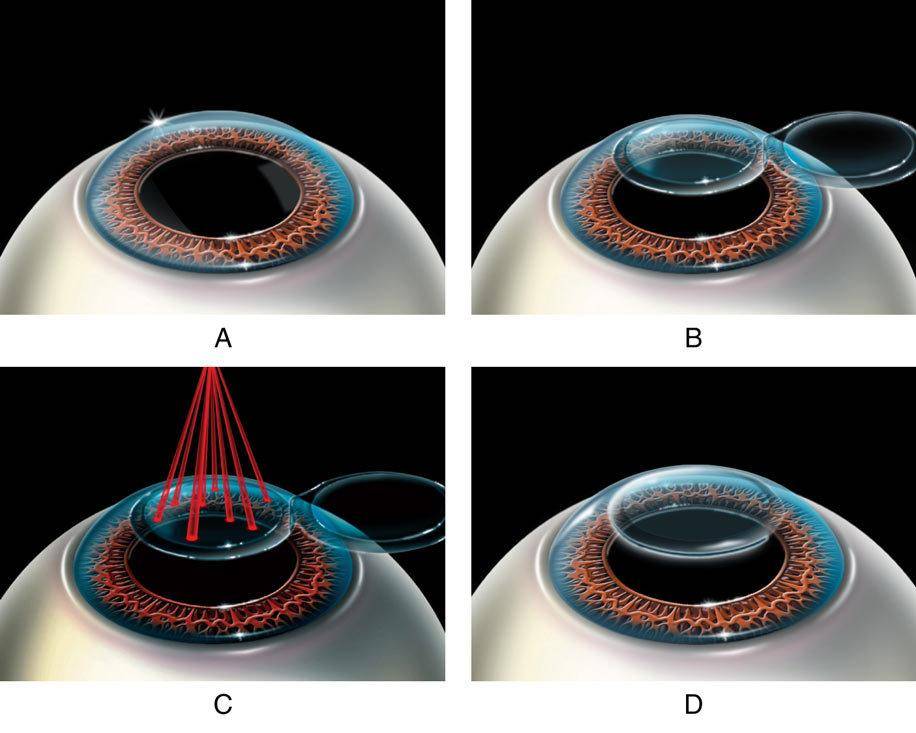 Операция на глазах ласик: отзывы, ограничения после лазерной коррекции lasik, последствия