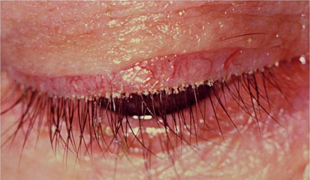 Блефарит чешуйчатый: симптомы и лечение заболевания