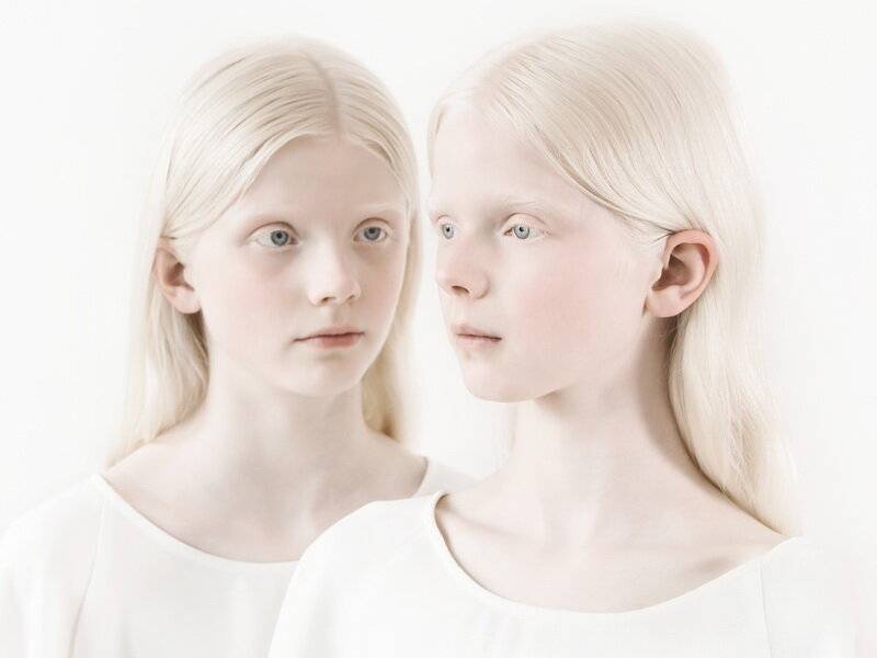 Дети-альбиносы. в чём причина и как проявляется заболевание?