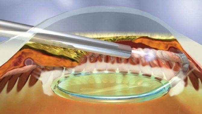 Селективная лазерная трабекулопластика (слт) при глаукоме