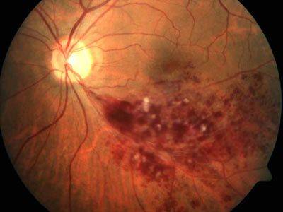 Дистрофия сетчатки глаза: что это такое, опасно ли это, виды заболевания, симптомы, диагностика и профилактика