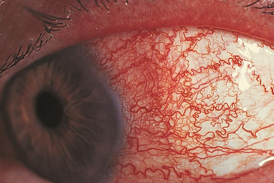 Склерит глаза: виды, причины, симптомы, лечение и осложнения