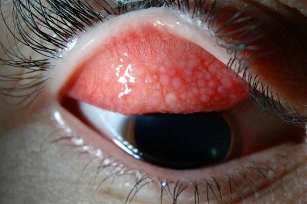 Хламидийный конъюнктивит: симптомы, лечение хламидиоза глаз