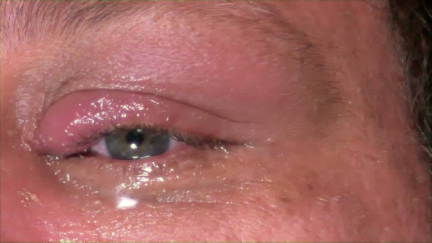 Наружный (внешний) ячмень на глазу: симптомы и лечение
