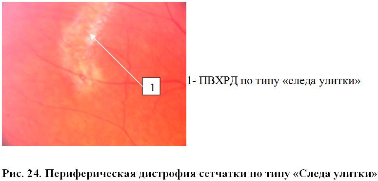 Периферическая дегенерация сетчатки глаза: причины, симптомы, лечение
