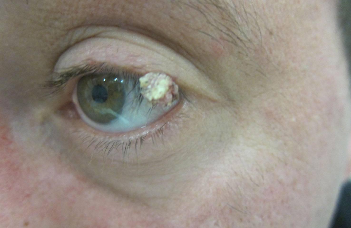 Жировик на веках глаз (липома): причины, виды, лечение - "здоровое око"