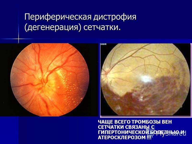 7 разновидностей периферической дистрофии сетчатки: причины и симптомы. как избежать слепоты?