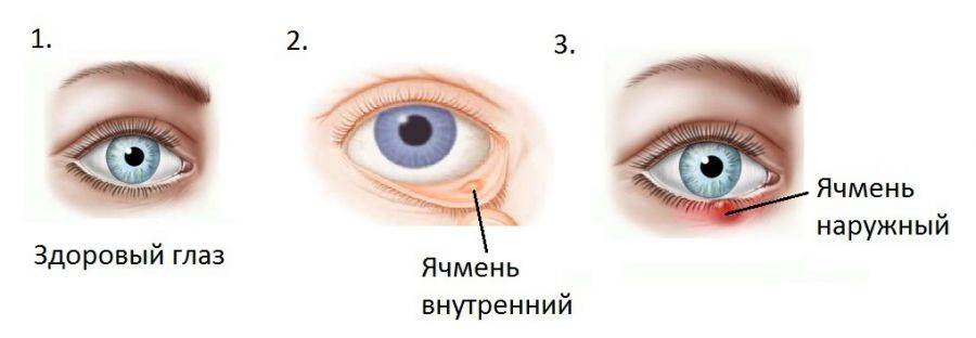 Что делать, если назревает ячмень на глазу? первые признаки и симптомы