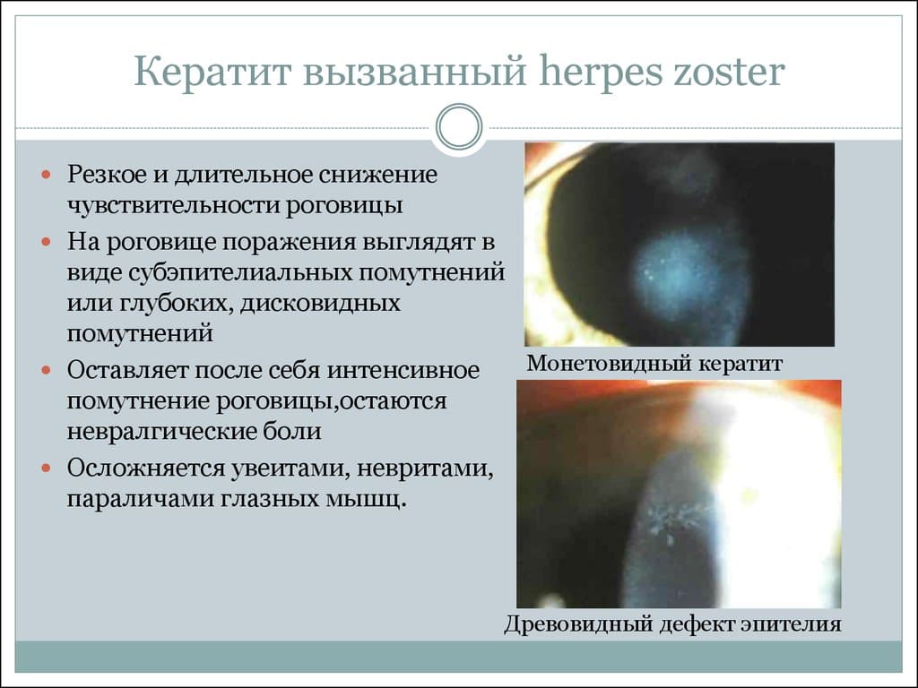 Герпетические поражения глаз (герпетический кератит)