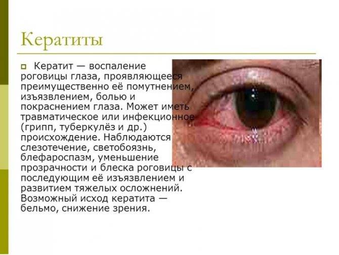 Кератит — симптомы и лечение воспаления роговицы глаза