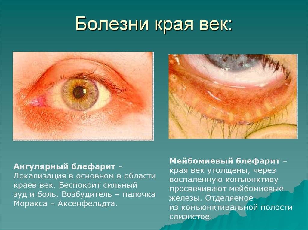 Список заболеваний глаз, их симптомы и лечение