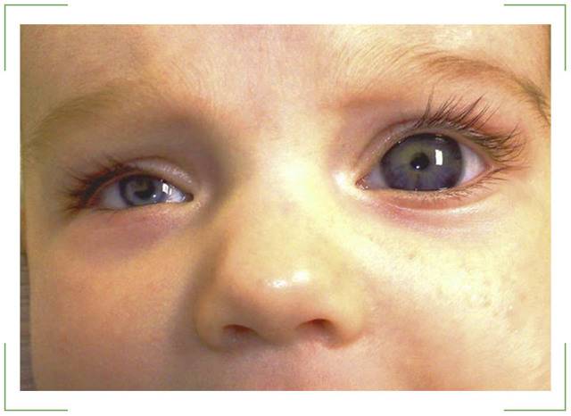 Почему один глаз больше другого: причины, симптомы и лечение - "здоровое око"