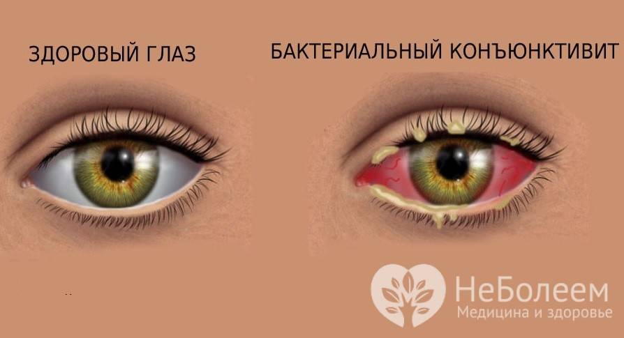Инфекционный конъюнктивит: причины, симптомы, лечение - "здоровое око"