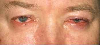 Блефароконъюнктивит глаз: причины, виды и эффективное лечение