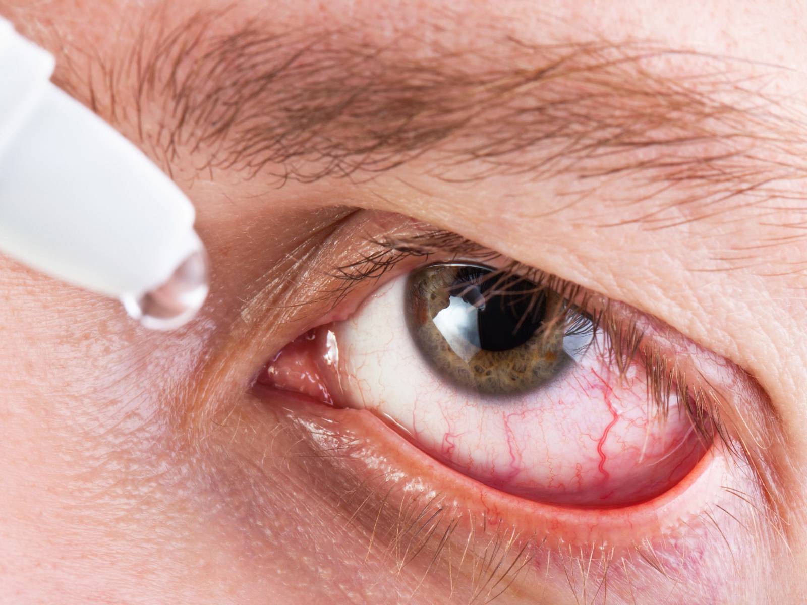 Слезотечение из глаз: причины, лечение, симптомы, осложнения и глазные капли от слезотечения