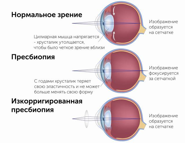 Пресбиопия: что это такое, лечение, причины, симптомы, диагностика, профилактика возрастной дальнозоркости, обоих глаз