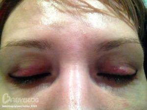 Гематома глаза после удара: лечение, как убрать на веке, под и над ним, вокруг зрительного органа