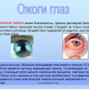 Лечение химических ожогов глаз разной степени и профилактика осложнений
