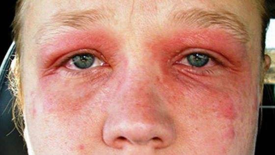 Аллергия на линзы – может ли быть, реакция на жидкость, раствор