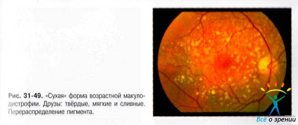 Макулодистрофия сетчатки глаза: причины, лечение - "здоровое око"