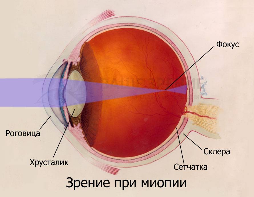 Как лечить нарушения аккомодации глаз у детей и взрослых