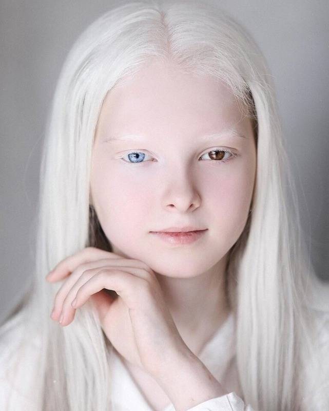 Альбинизм – у людей, признаки, у детей, типы, классификация, лечение