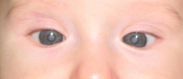 5 причин, по которым развивается катаракта у детей