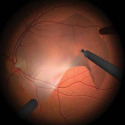 Эпиретинальный фиброз глаза лечение народными средствами - медицинская профилактика