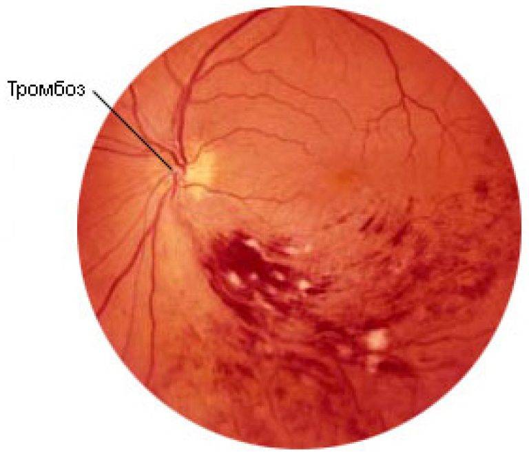 Тромбоз центральной вены сетчатки глаза: особенности течения, осложнения