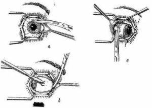 Что такое эвисцерация глазного яблока, показания к операции oculistic.ru
что такое эвисцерация глазного яблока, показания к операции