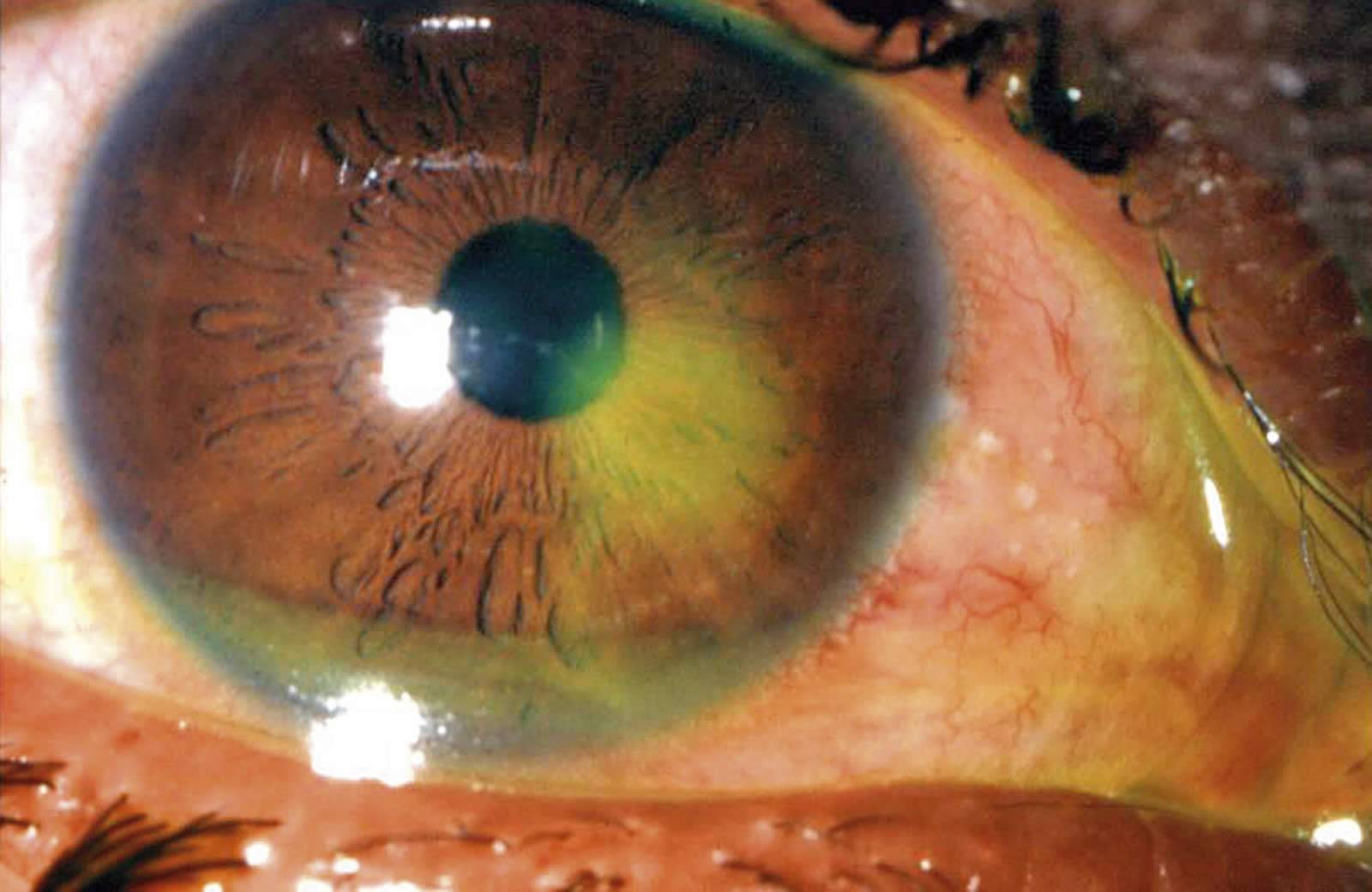 Ушиб глаза: первая помощь и лечение в домашних условиях