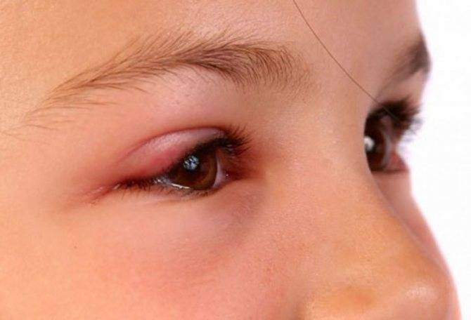 Быстрое и безопасное лечение ячменя на глазу у детей: капли, мази, народные примочки