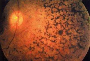 Амавроз лебера одного или обоих глаз: причины, лечение, виды (двухсторонний, врожденный)
