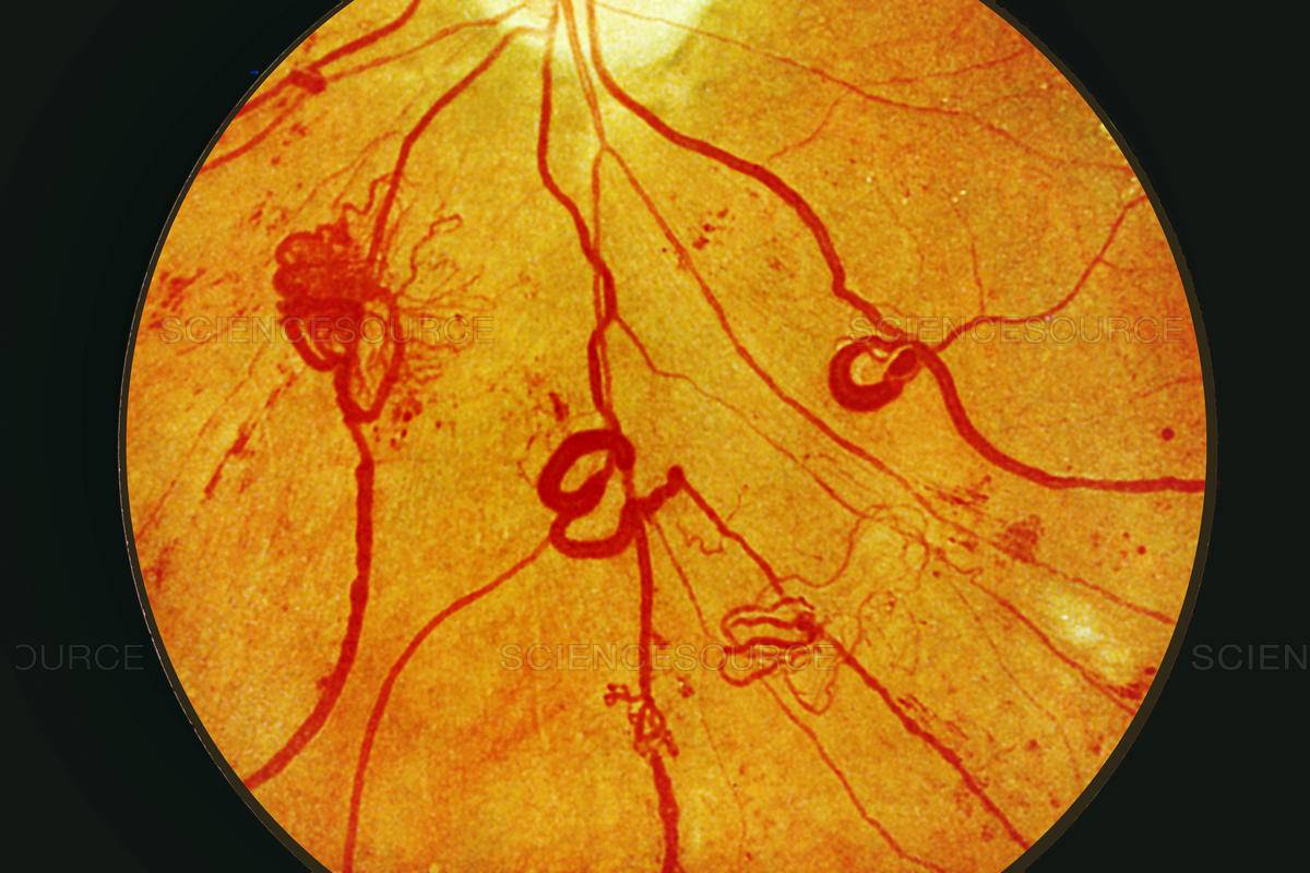 Что такое фоновая ретинопатия у детей и взрослых