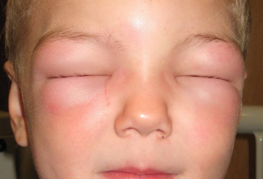 Аллергия на глазах: фото, симптомы на веках, вокруг глаз, отек при аллергии под глазами